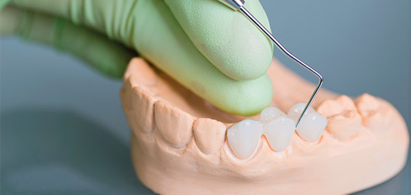 dental-moulds-600x286-1.jpg