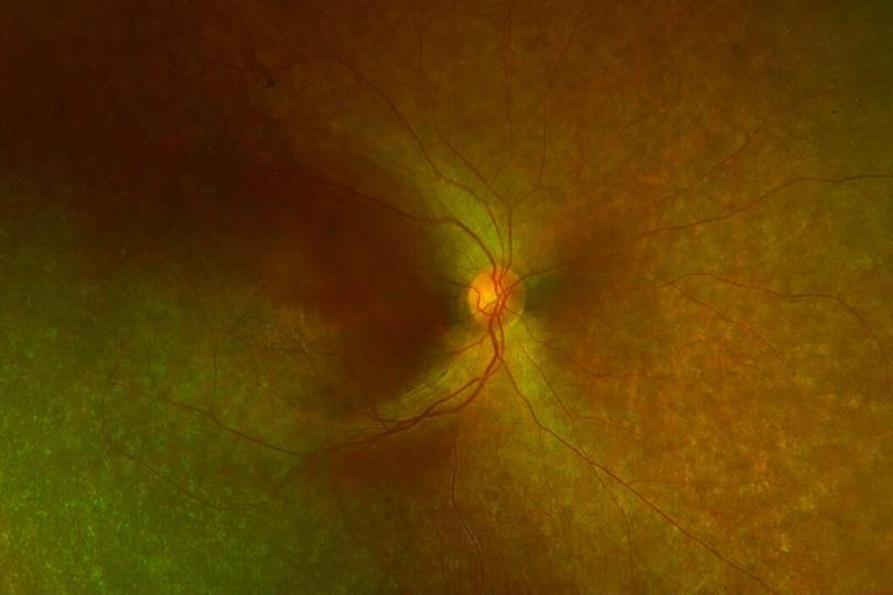 【病例研究】眼部基因治 疗<em>视网膜</em>下注射