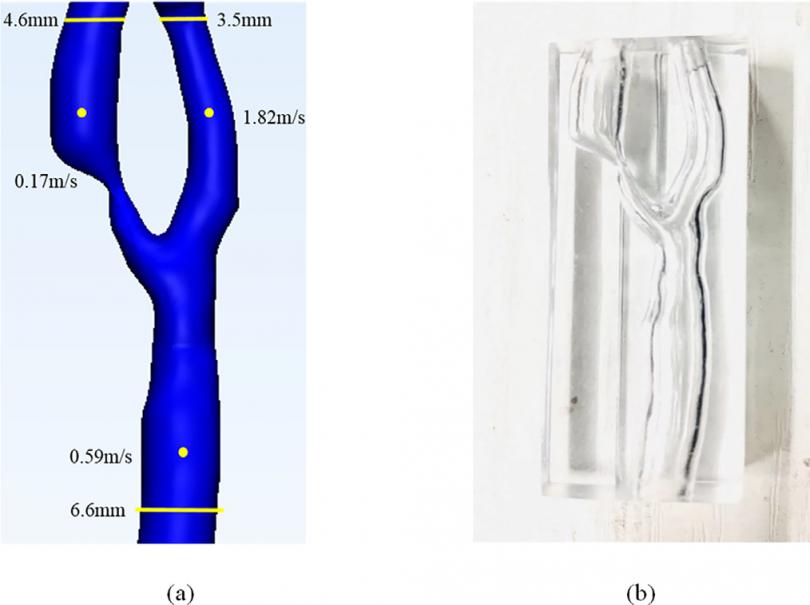 颈动脉狭窄相关径向截面速度分布和管壁剪应力研究