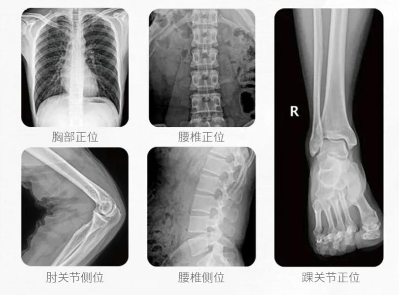 移动式DR临床影像