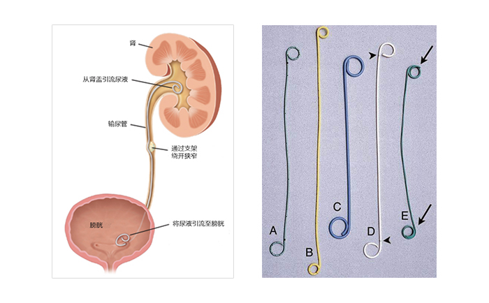 输尿管支架工作原理及常见的双J管
