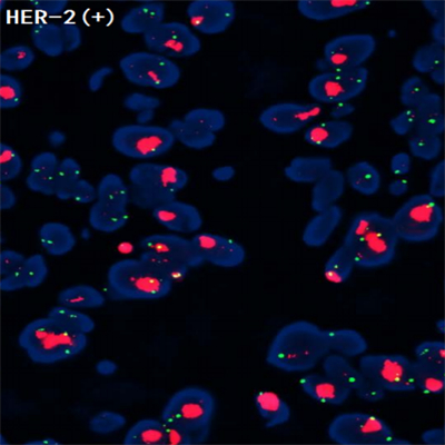 异常乳腺检测标本在荧光显微镜下的状态-广州明慧