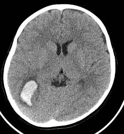 脑出血磁共振图片图片